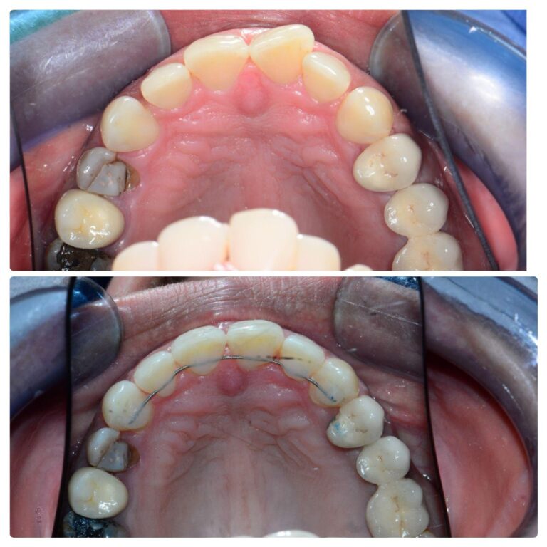 Before and after clear aligner case, The Smile Correct