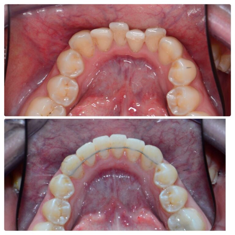 Before and after clear aligner case, The Smile Correct