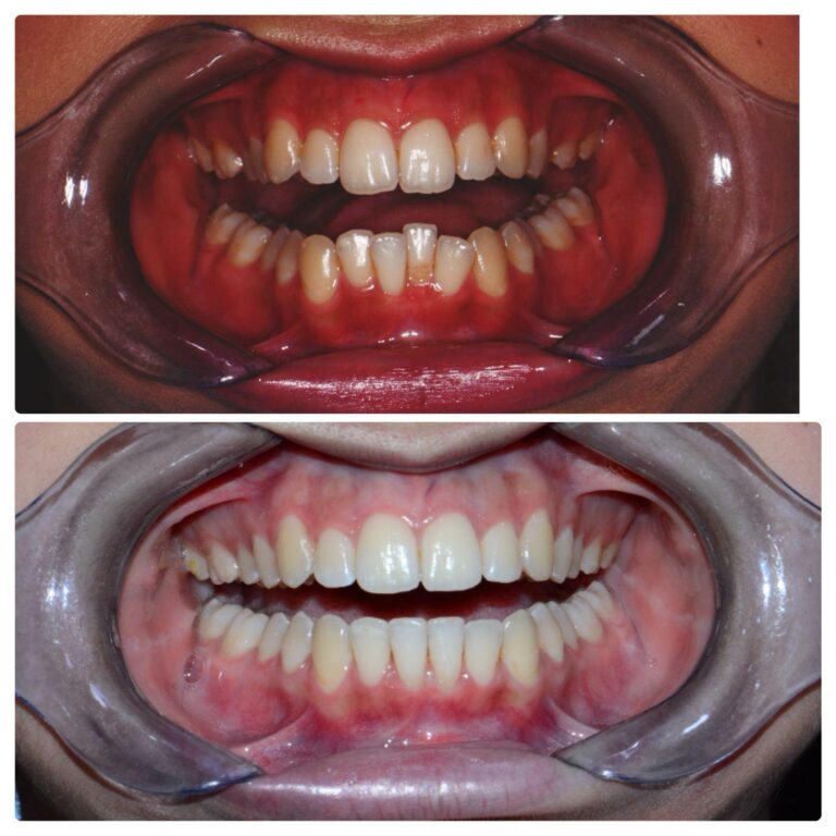 Before and after clear aligner case, The Smile Correct
