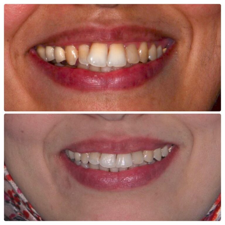 Before and after clear aligner case, The Smile Correct